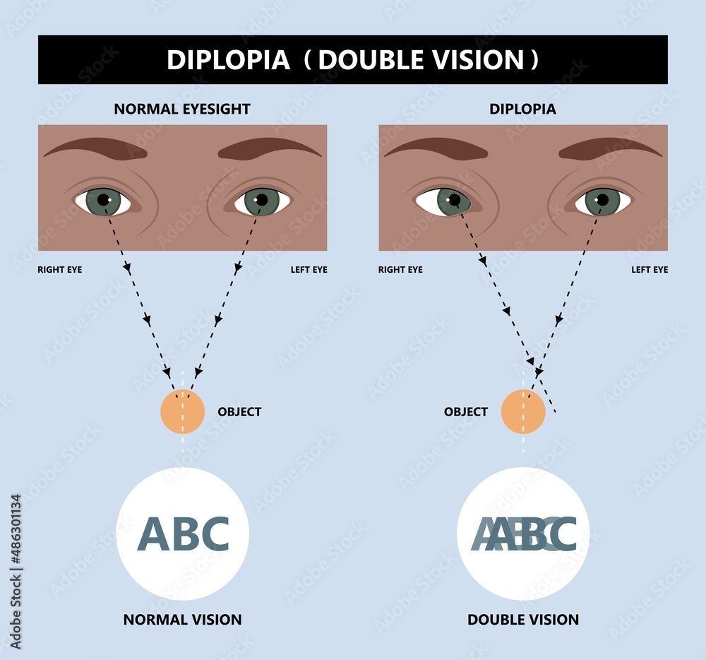 Treatment Methods for Diplopia